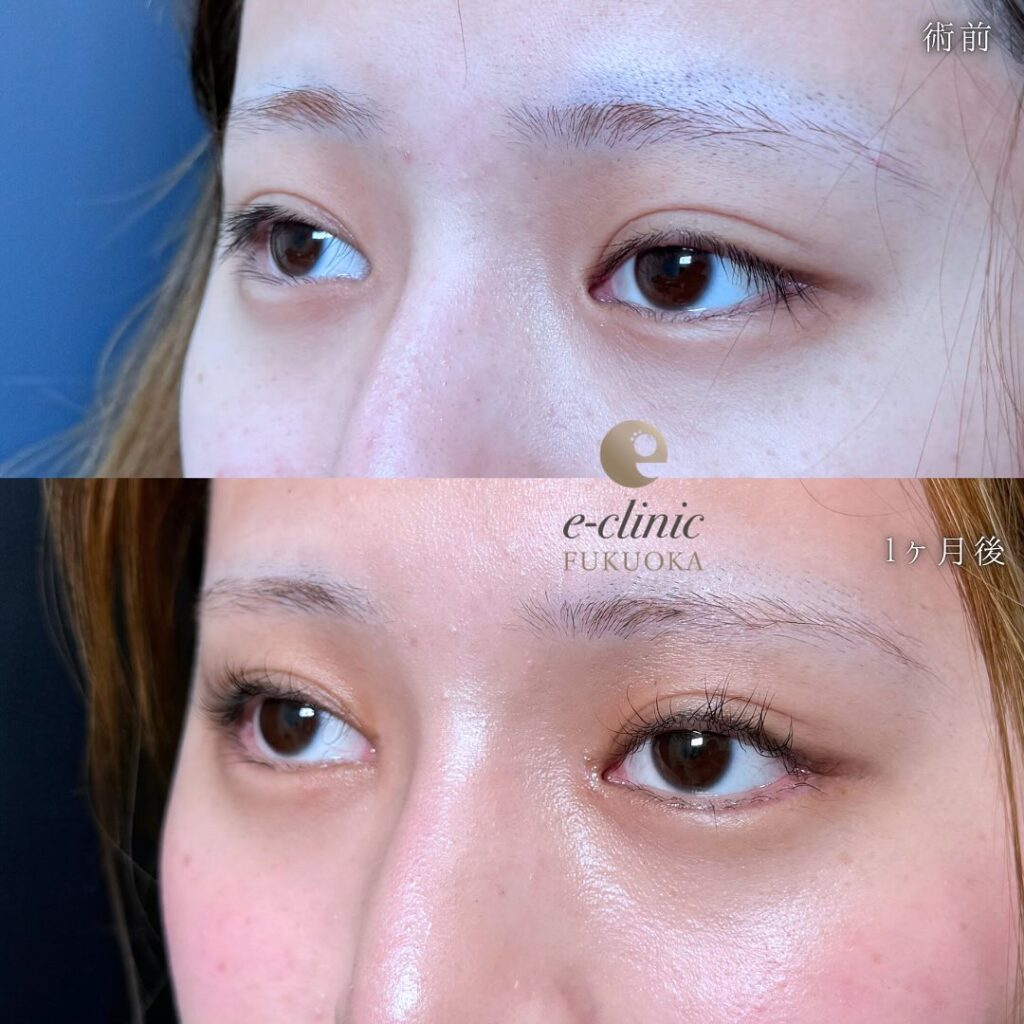 タレ目形成と目尻切開と目頭切開の症例写真 (2)