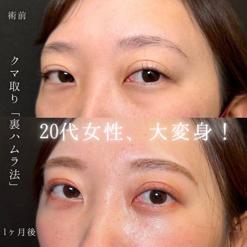 裏ハムラ法の症例写真 (39)