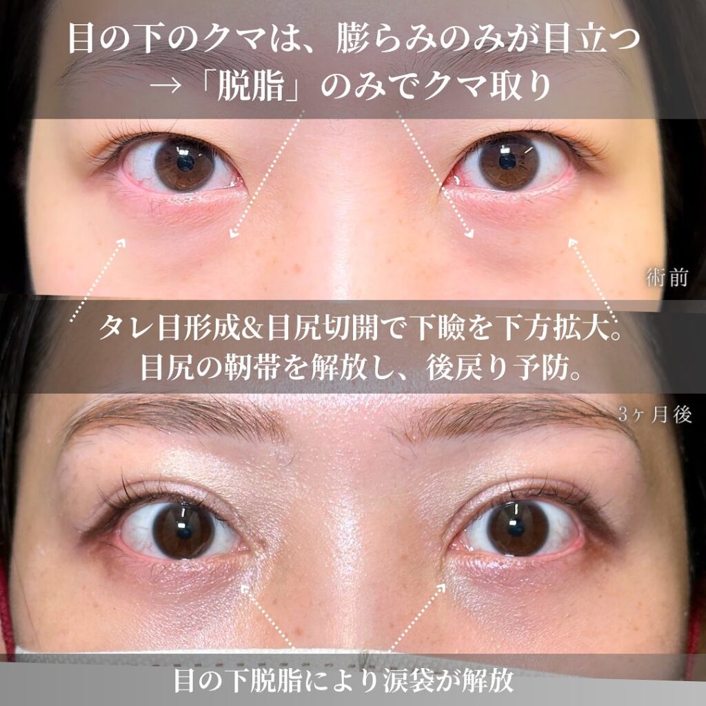 目の全方向拡大と脱脂の症例写真 (3)