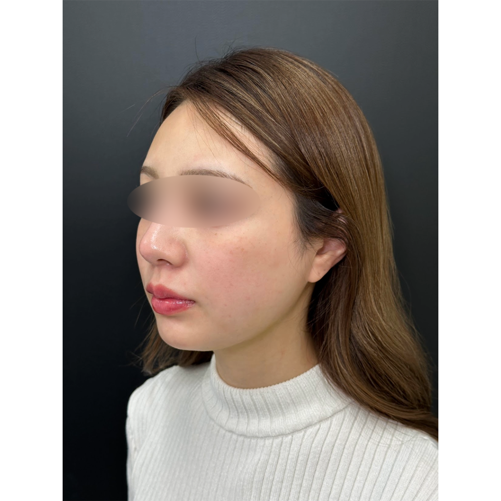 eクリニック福岡院の小顔脂肪吸引＋糸リフトの症例写真（名医の伊藤渉医師が執刀）・頬・顎下・ジョールファット脂肪吸引
・バッカルファット除去
・糸リフト（スレッドリフト8本）