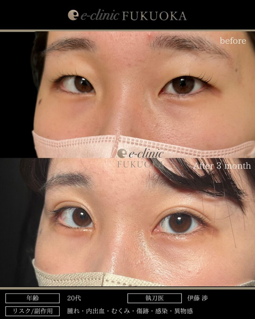 埋没法と目頭切開の症例写真 (8)