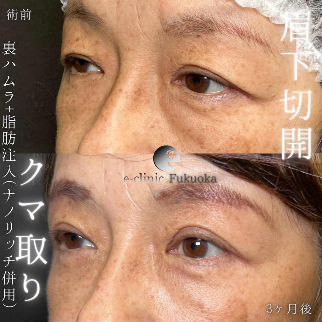 裏ハムラ方と眉下切開と脂肪注入の症例写真 (2)