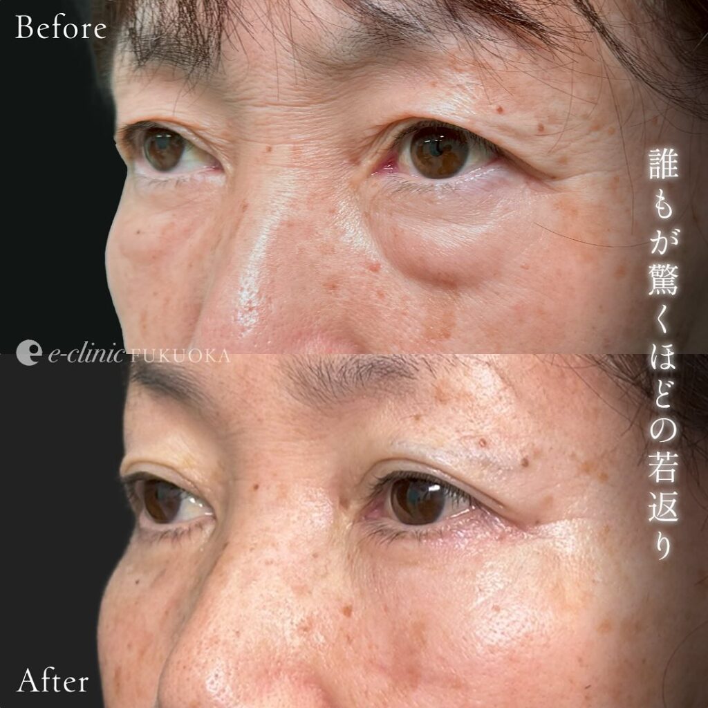 表ハムラ法の症例写真 (2)