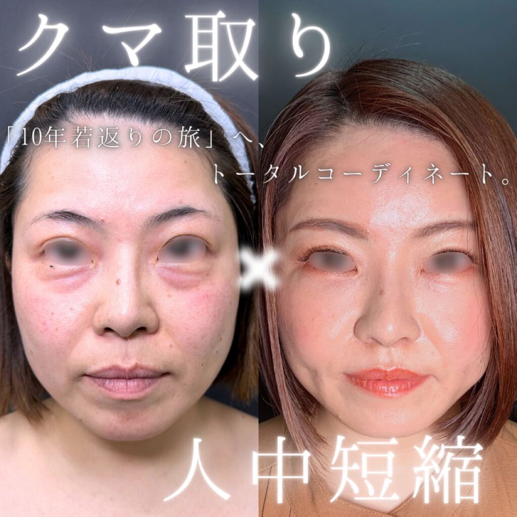 裏ハムラ方と脂肪注入と人中短縮 の症例写真 (1)