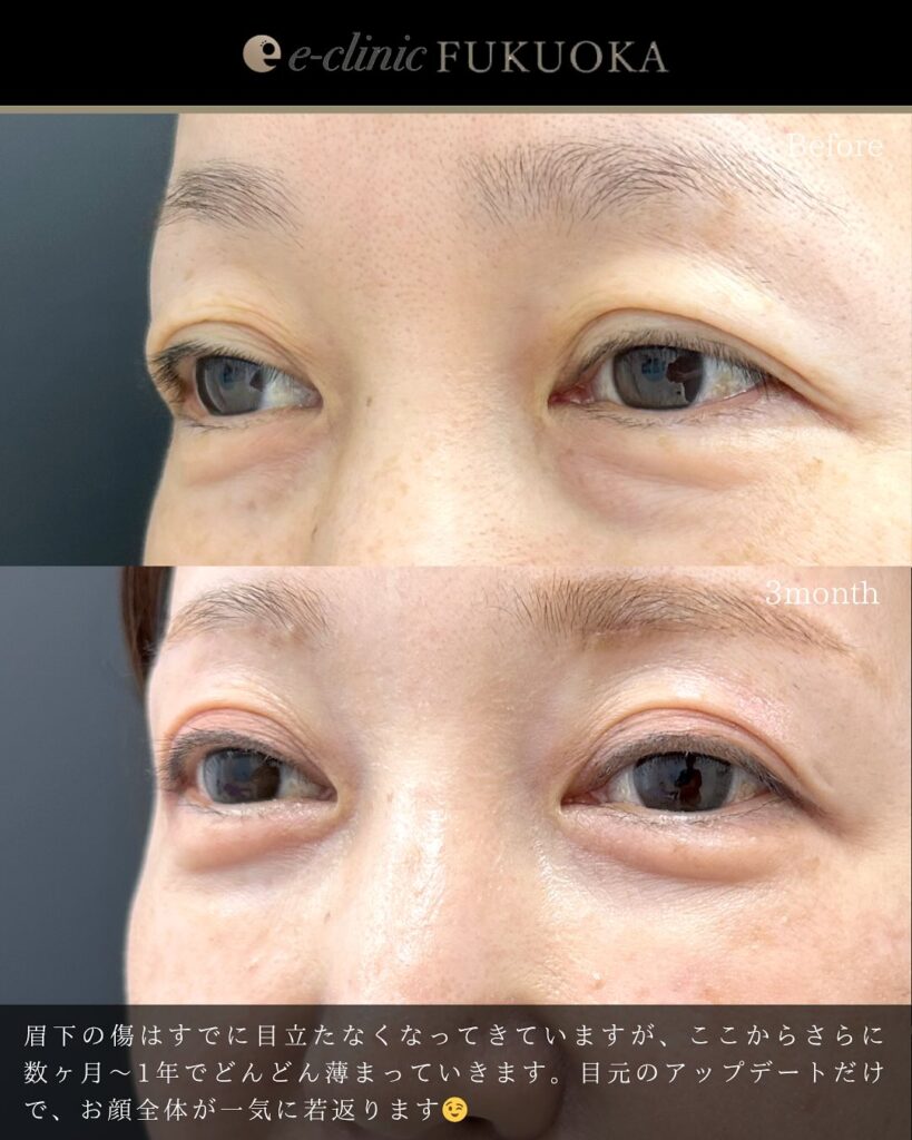 眉下切開と裏ハムラ法の症例写真 (1)