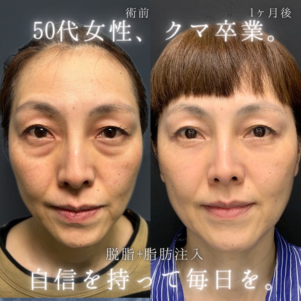 脱脂と脂肪注入の症例写真 (1)