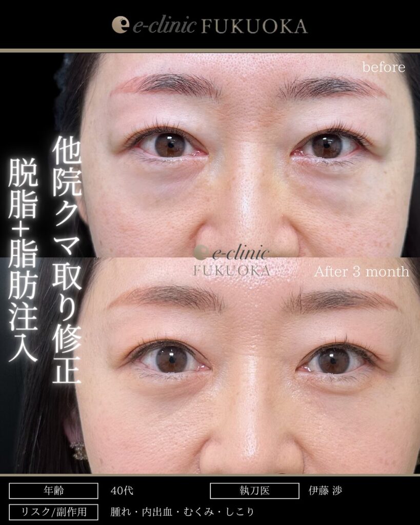 他院のクマ取り修正と脂肪注入と脱脂の症例写真 (1)