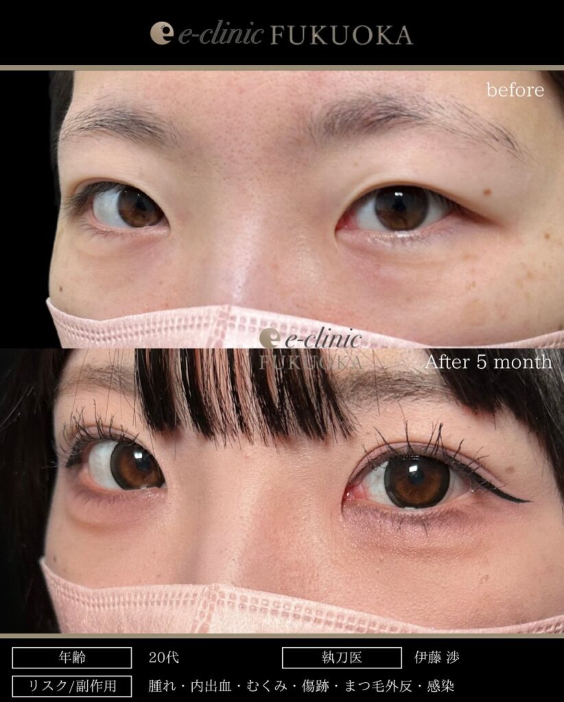 全切開の症例写真 (4)