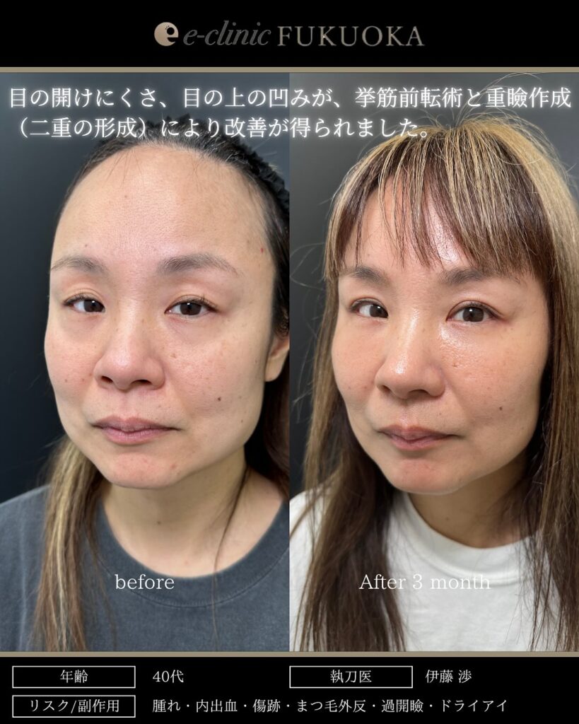 全切開と眼瞼下垂の症例写真 (3)