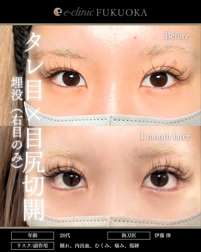 タレ目形成と目尻切開と埋没法の症例写真 (1)