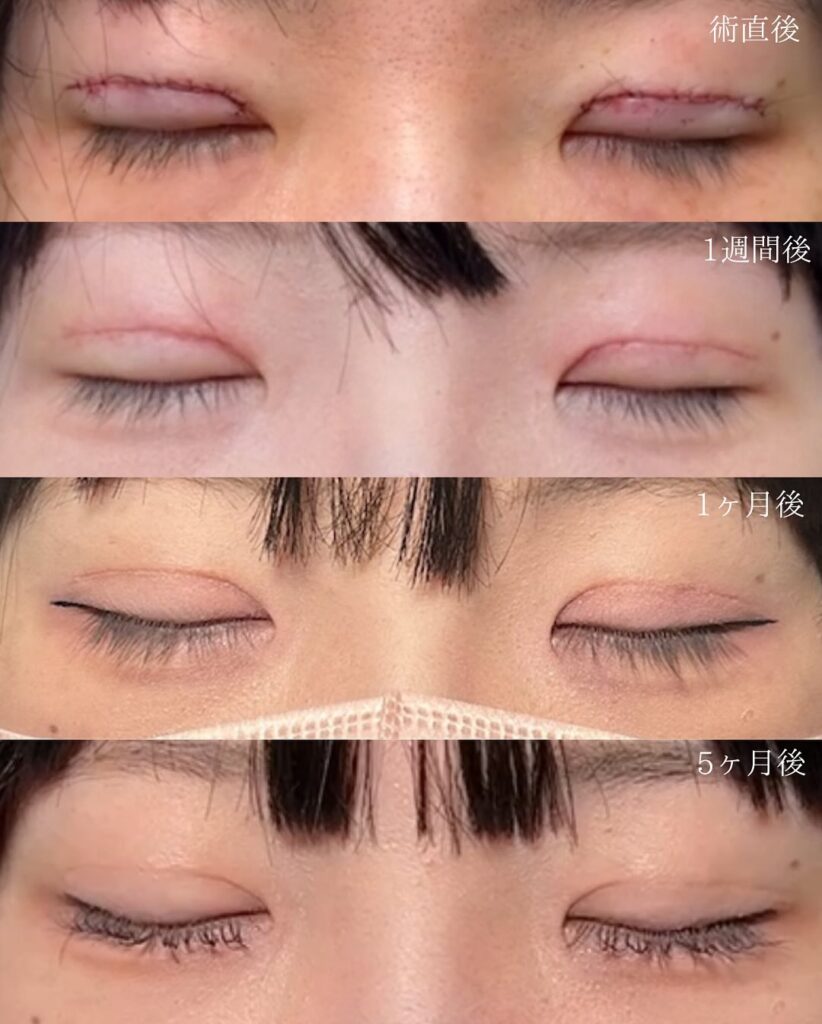 全切開の症例写真 (2)