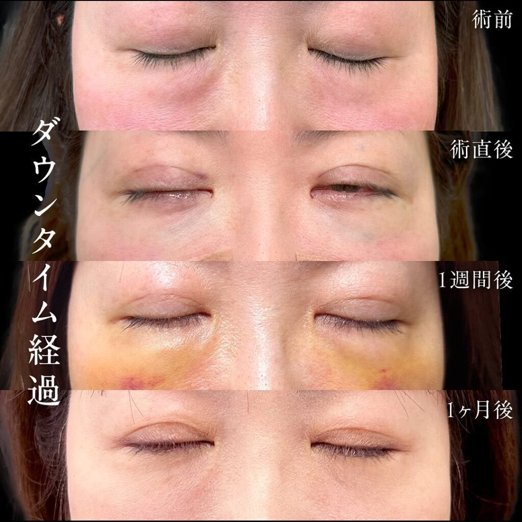 裏ハムラ法と埋没法の症例写真 (8)