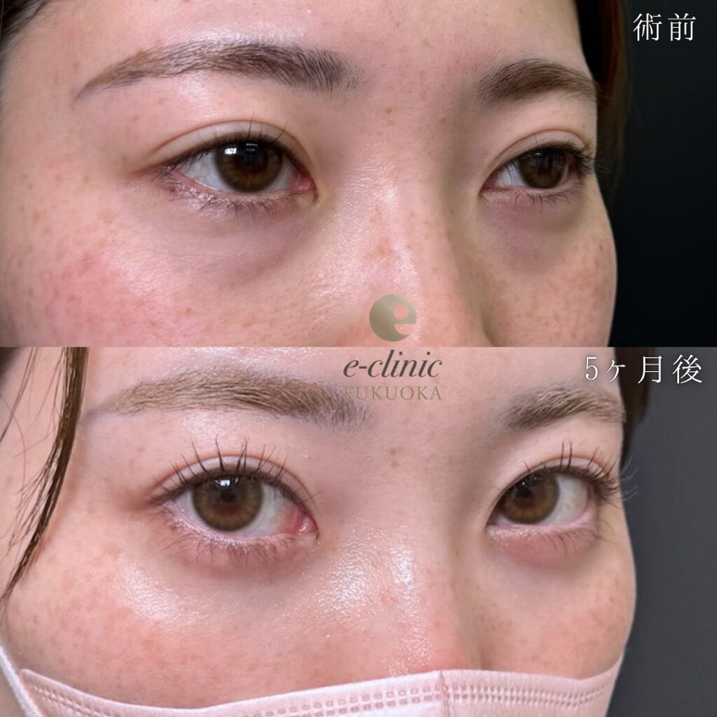 裏ハムラ法の症例写真 (80)