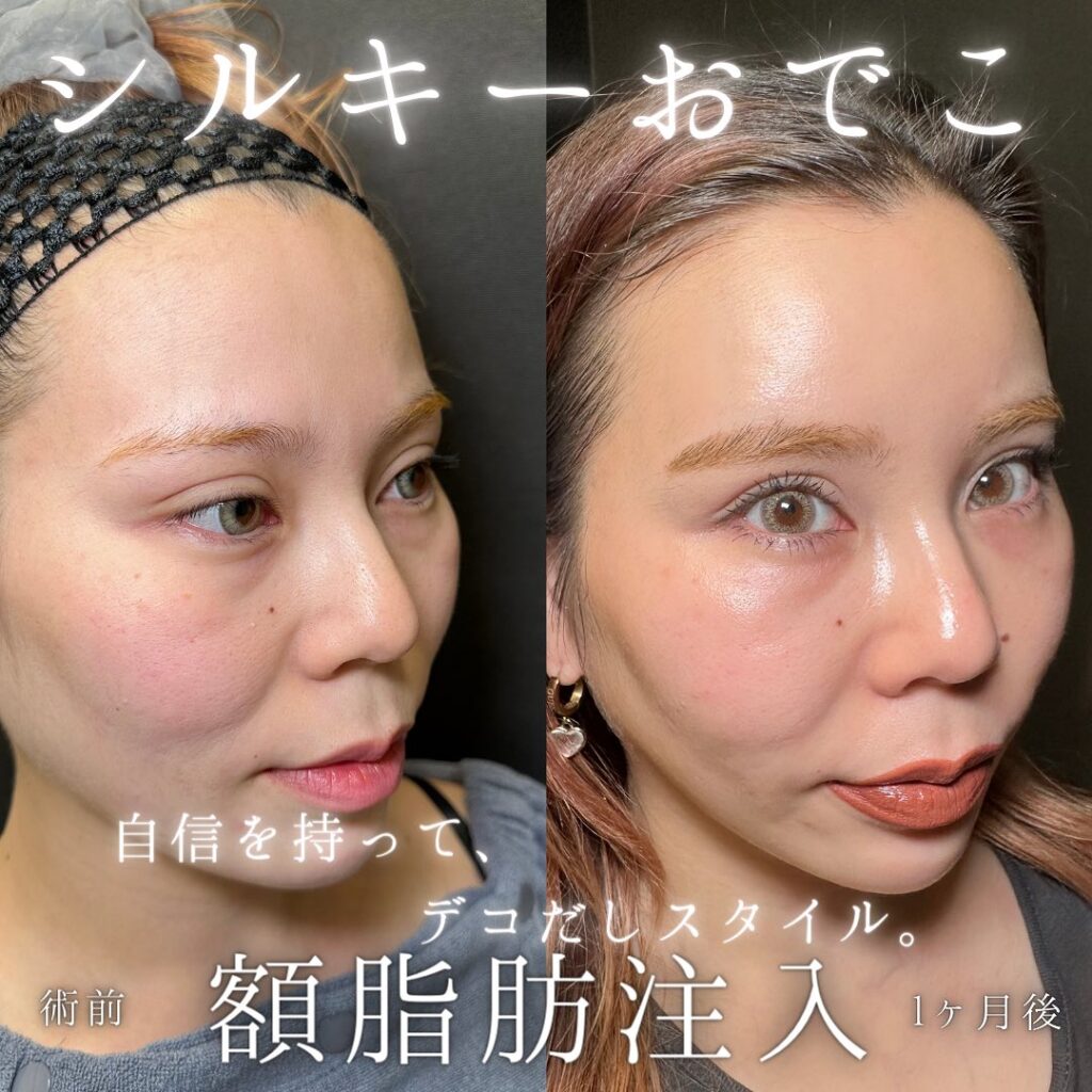 額の脂肪注入の症例写真 (1)