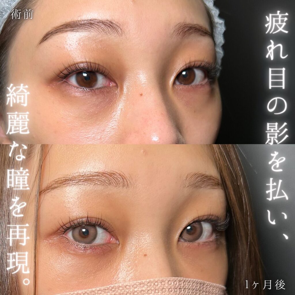 裏ハムラ法と涙袋と目の下のヒアルロン酸の症例写真 (2)