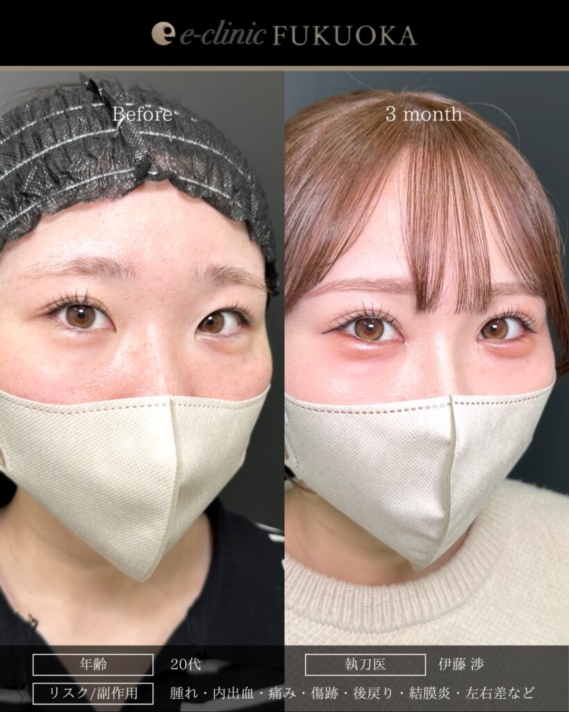 埋没法と目頭切開の症例写真 (11)