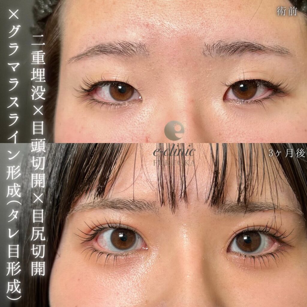 埋没法と目頭切開と目尻切開とタレ目形成の症例写真 (6)