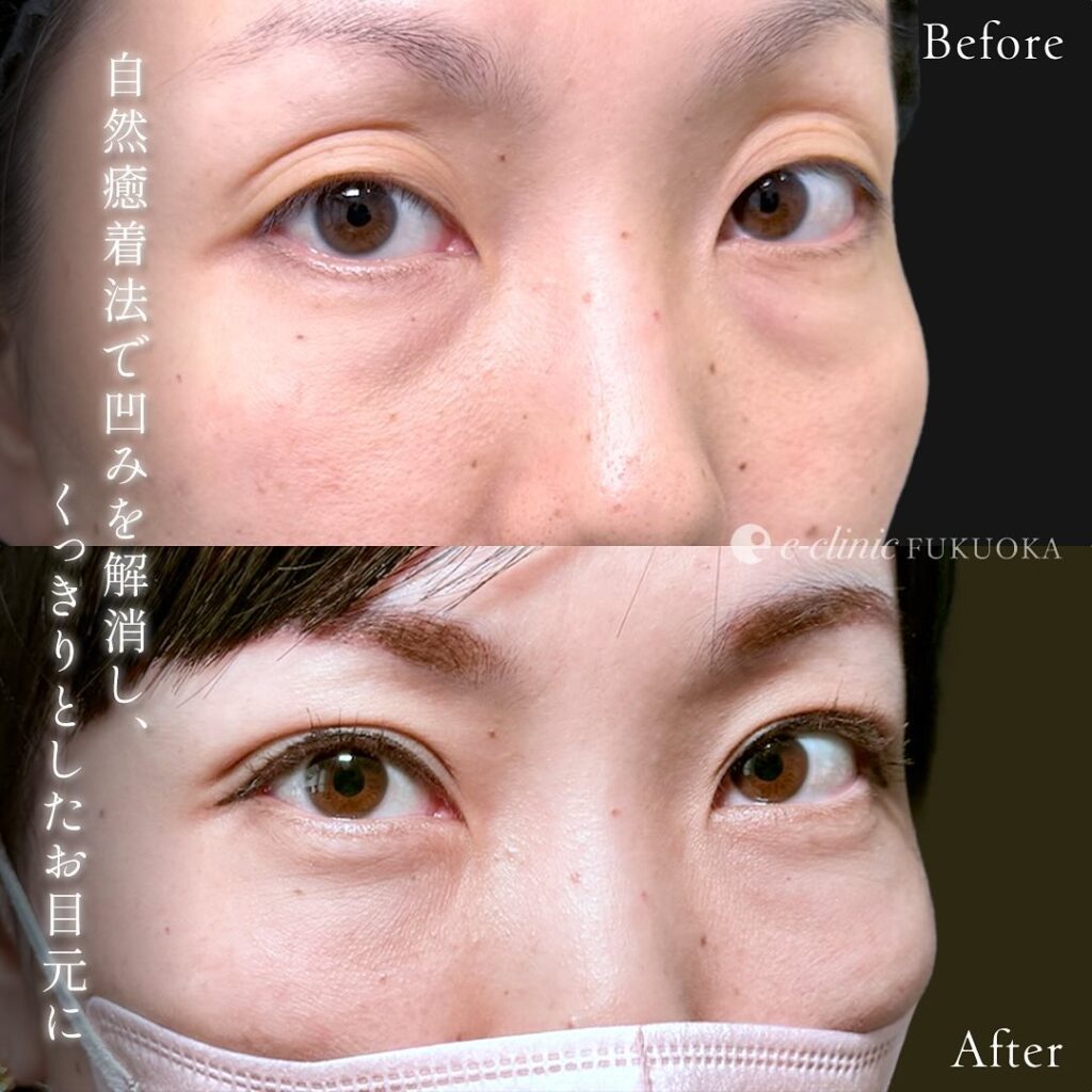 裏ハムラ法と自然癒着法の症例写真 (3)