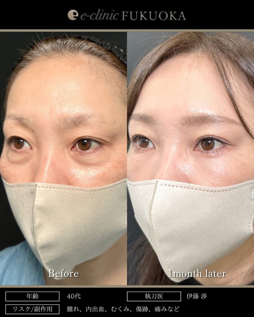 目の下のたるみ取りと脱脂と脂肪注入の症例写真 (2)