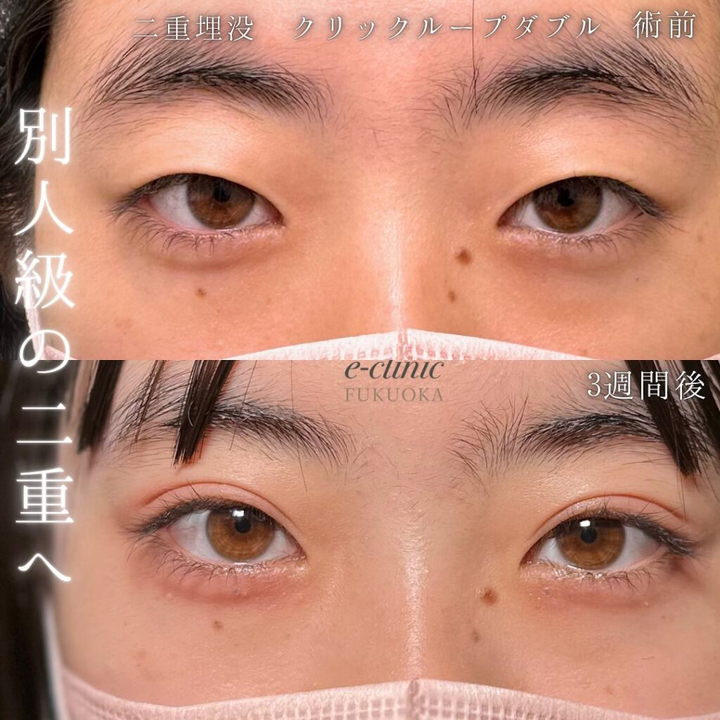 埋没法の症例写真 (11)