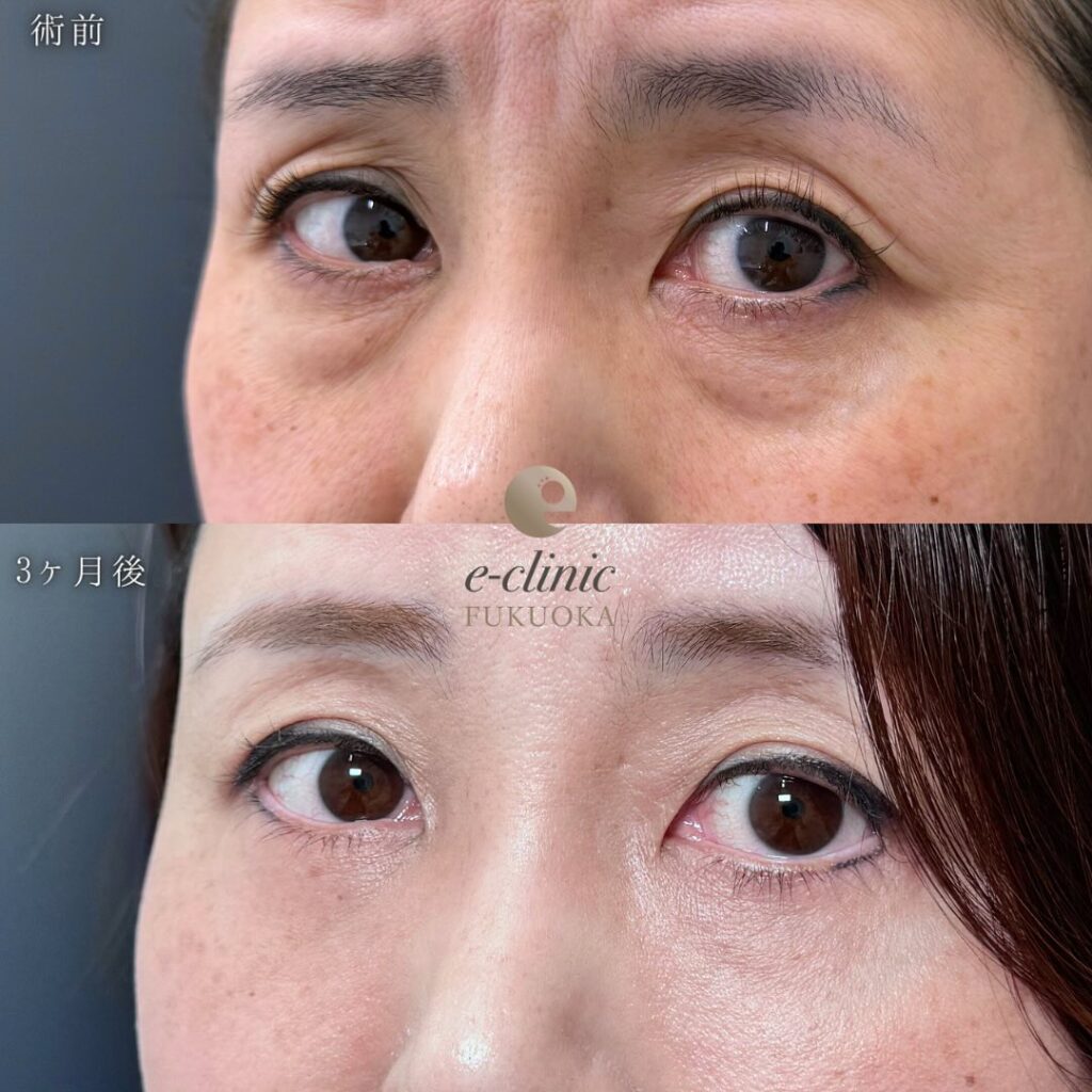 裏ハムラ法と目の下の脂肪注入と額とこめかみの脂肪注入の症例写真 (2)