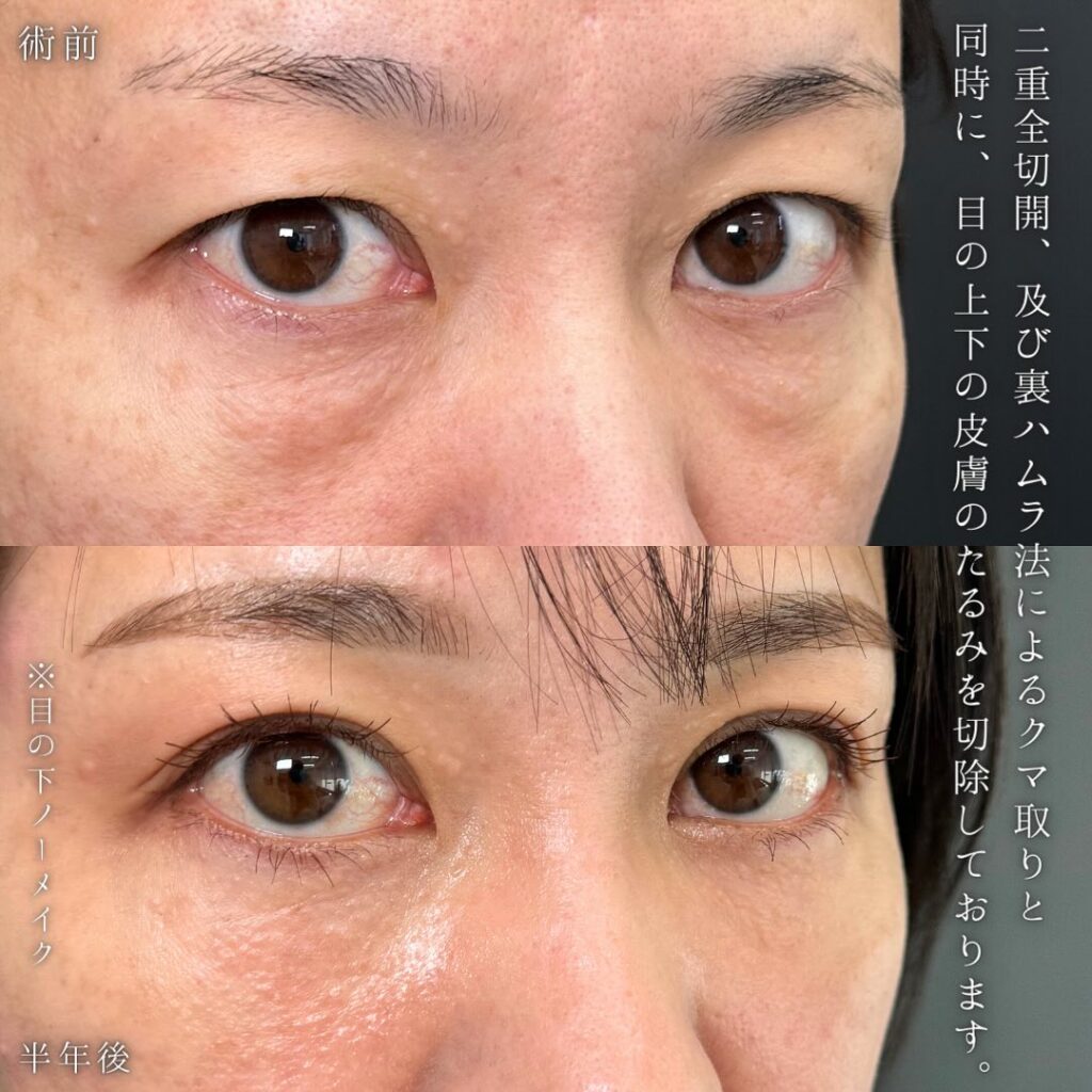 全切開と裏ハムラ法の症例写真 (3)