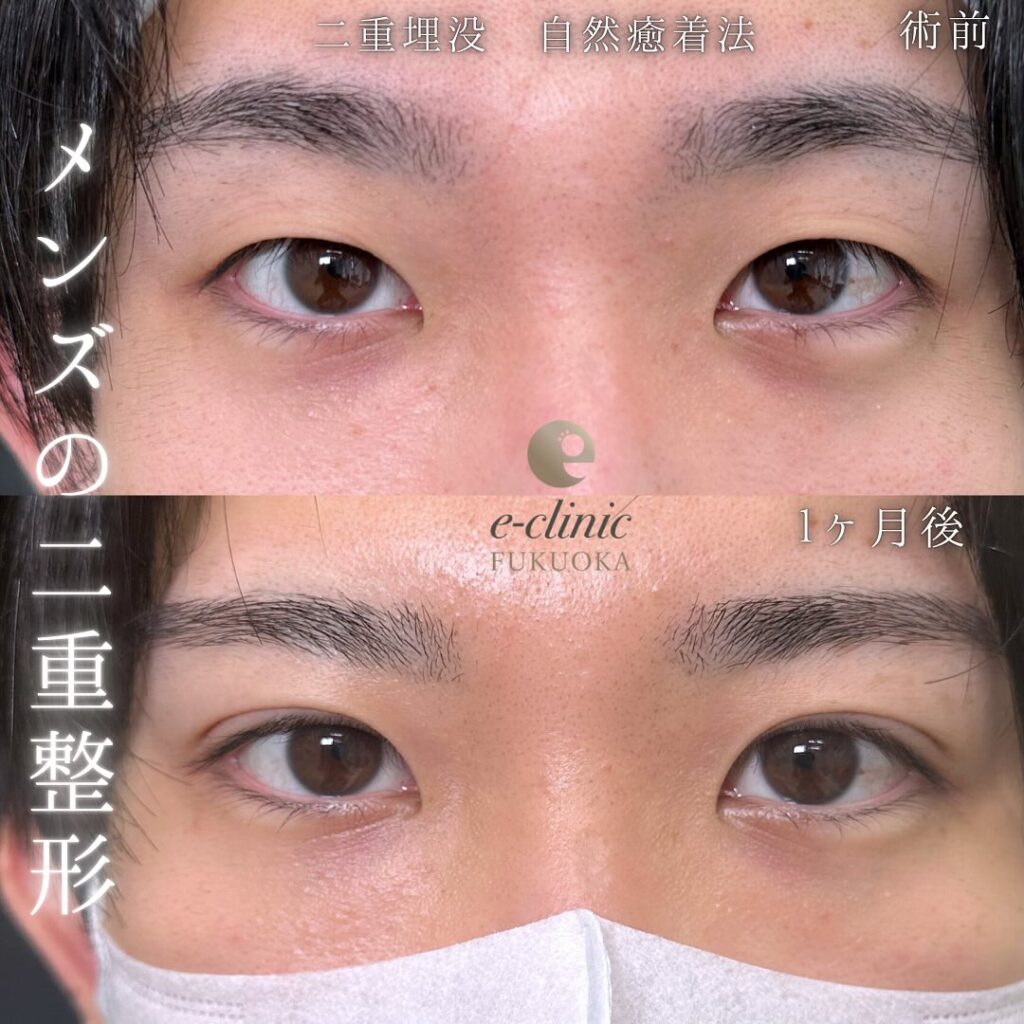 自然癒着法の症例写真