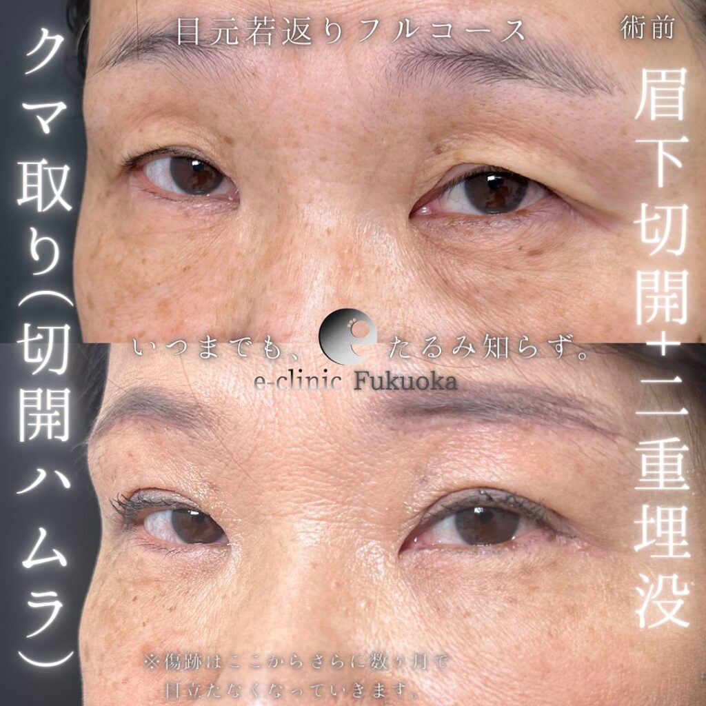 切開ハムラと眉下切開と埋没法の症例写真 (3)