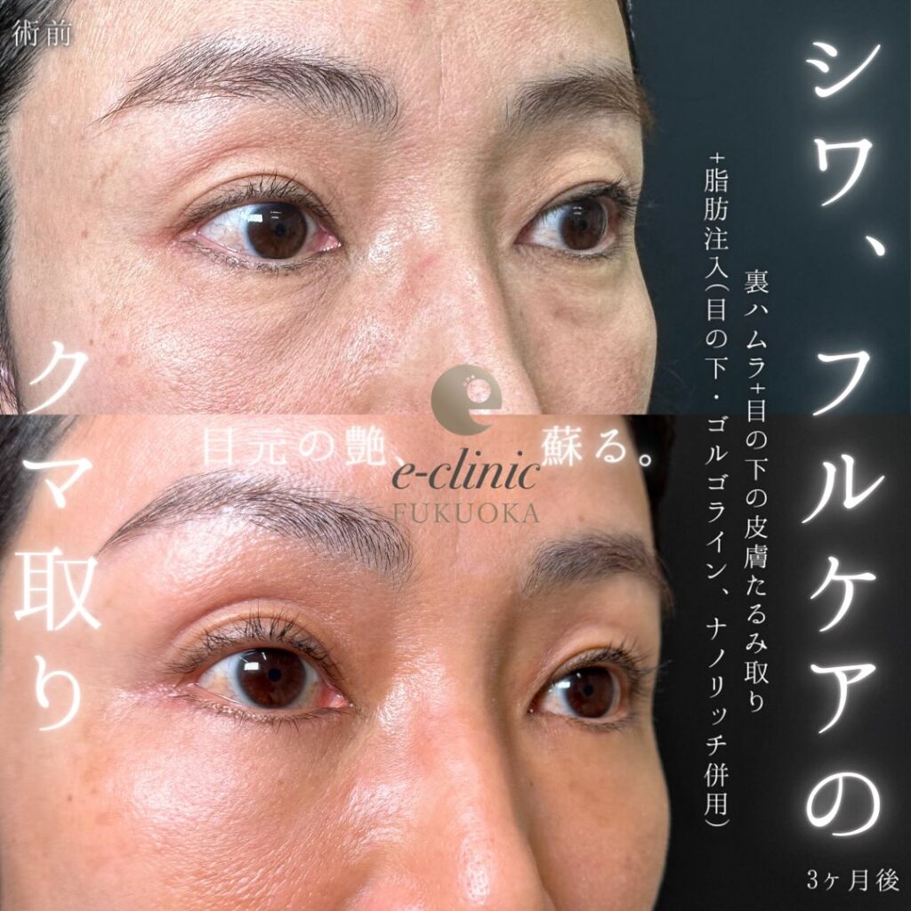 裏ハムラ法と脂肪注入の症例写真 (17)