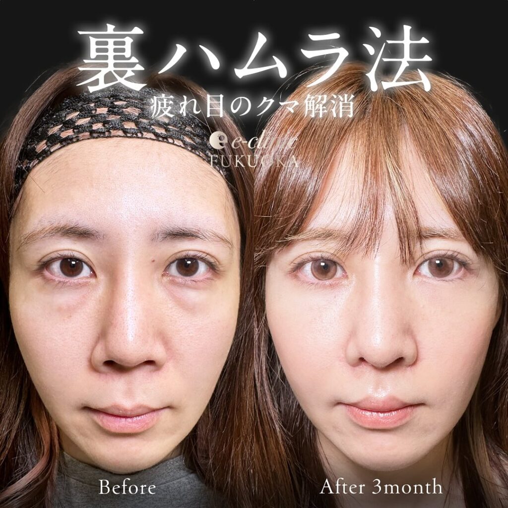 裏ハムラ法の症例写真 (82)