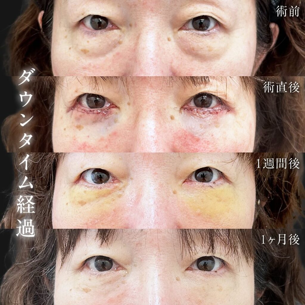 他院修正と表ハムラ法症例写真 (2)