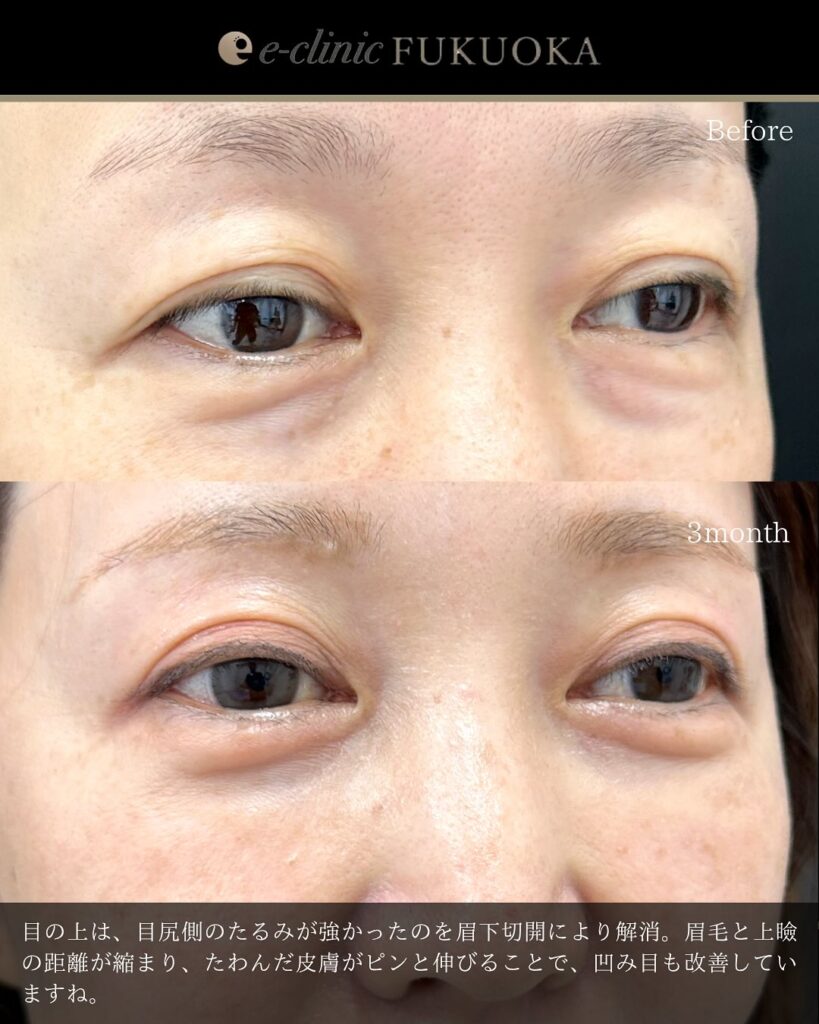 眉下切開と裏ハムラ法の症例写真 (3)