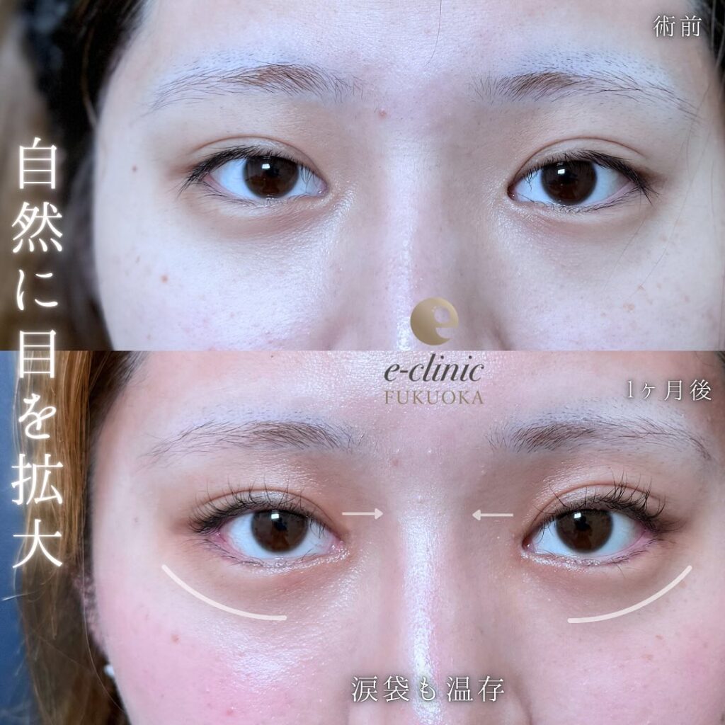 タレ目形成と目尻切開と目頭切開の症例写真 (4)