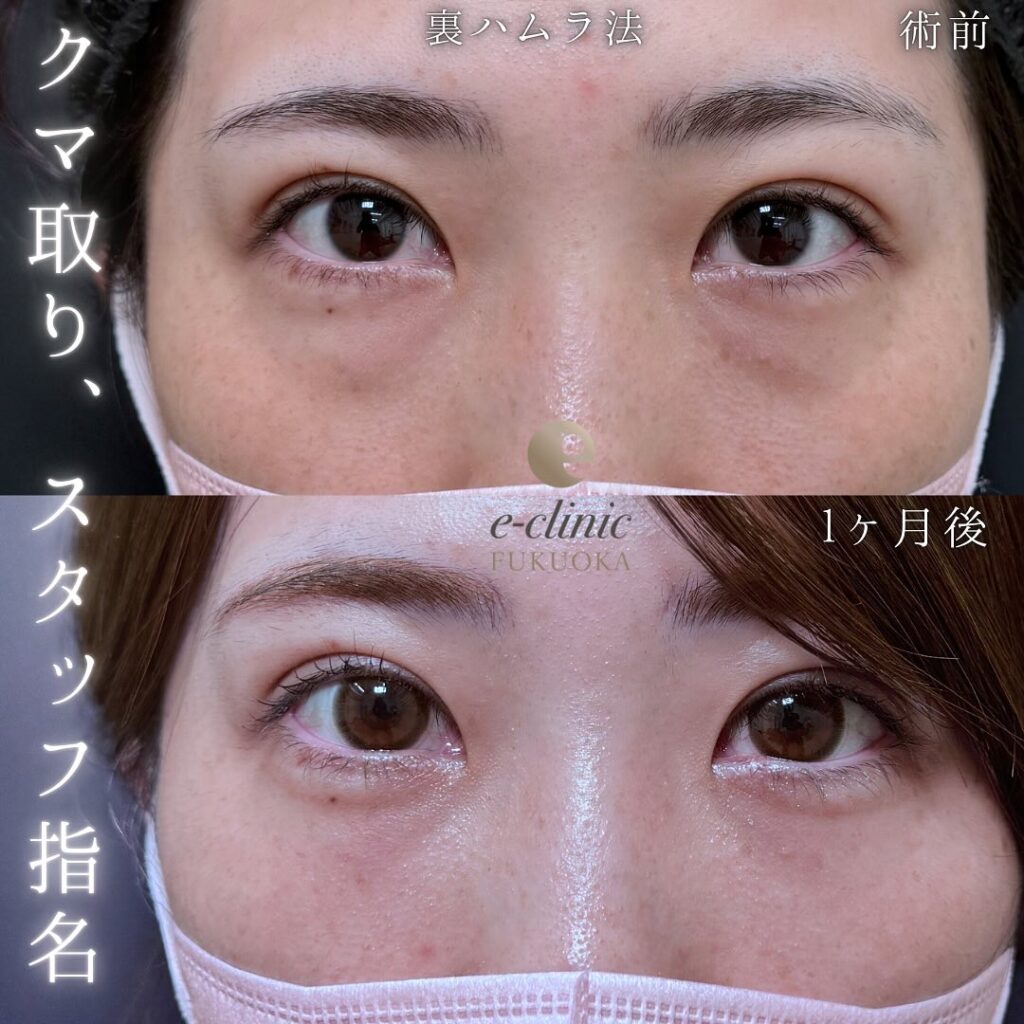 腫れ、内出血、むくみ、傷跡、痛みを生じる事があります。
なるべく、リスクや副作用が出ないように配慮して手術を行っています。