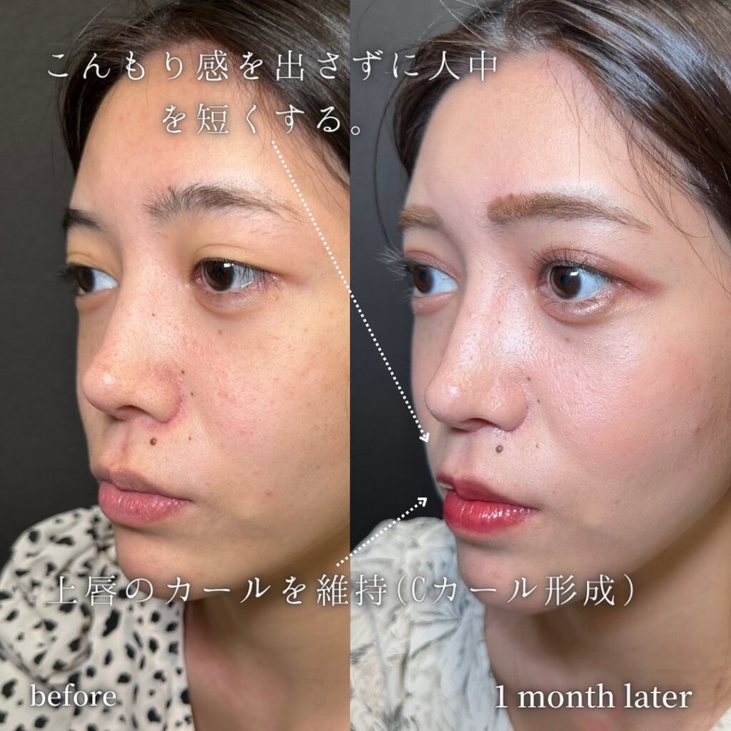 人中短縮の症例写真 (3)