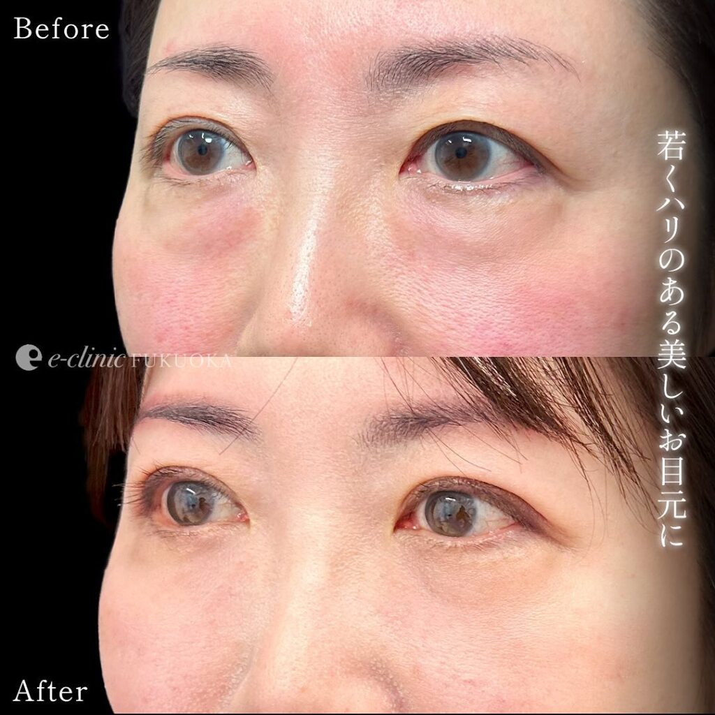 裏ハムラ法と埋没法の症例写真 (10)