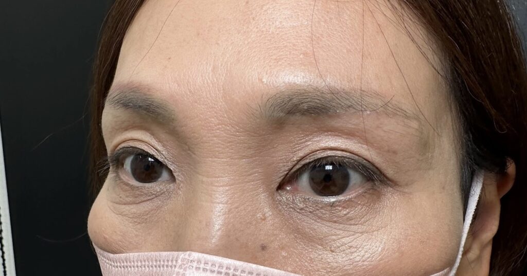 eクリニック福岡院の眉下切開の症例写真（術後3ヶ月時点）（名医の伊藤渉医師が執刀）