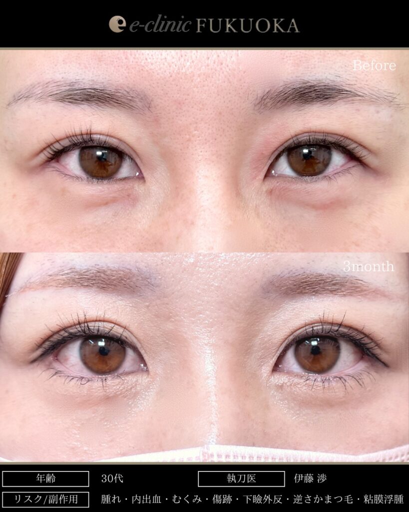 タレ目形成と目尻切開と脱脂とクマ取りの症例写真 (2)