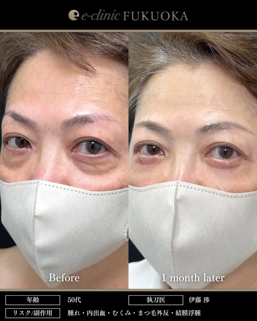 裏ハムラ法とナノリッチとボトックスの症例写真 (3)