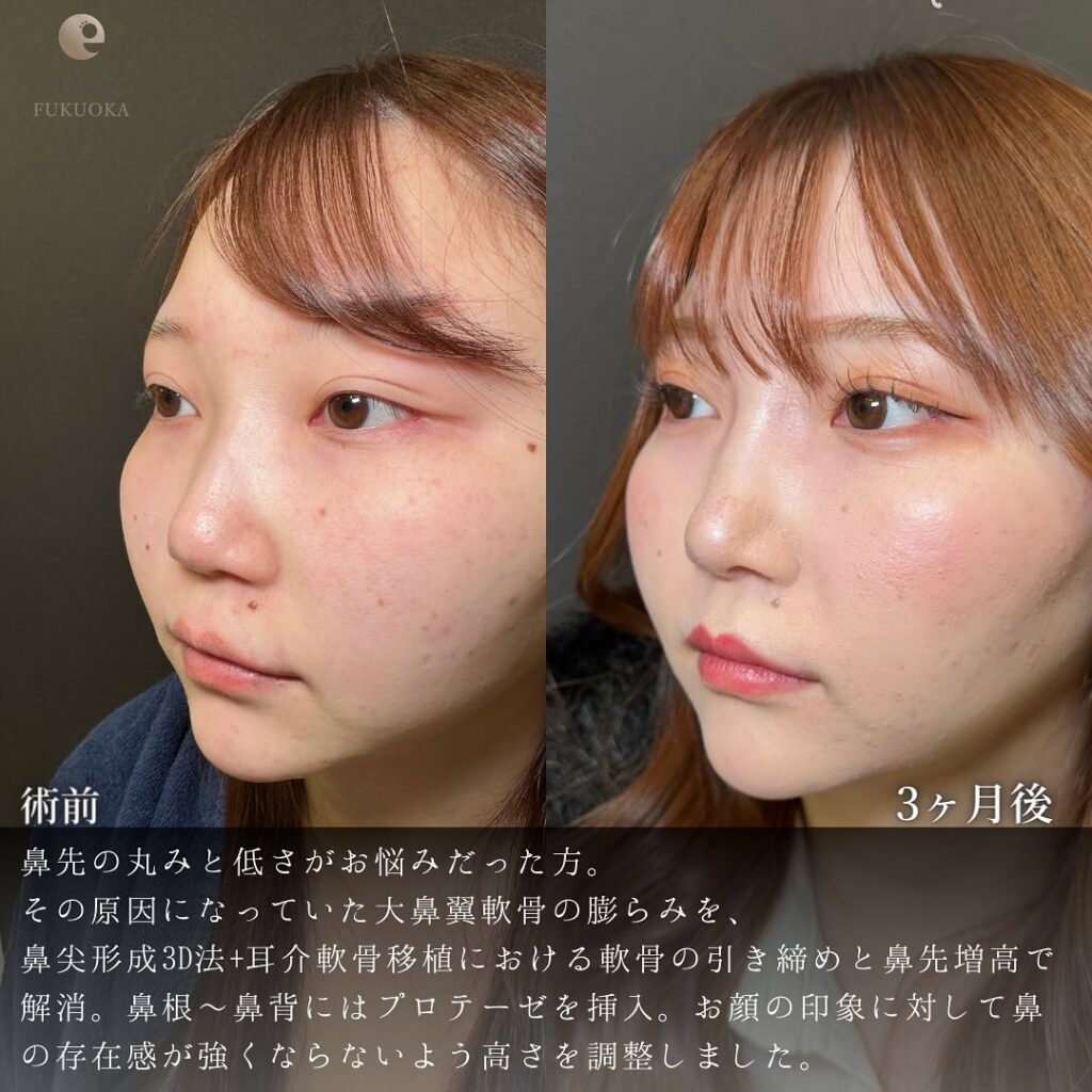 鼻尖形成と軟骨移植と耳介軟骨移植と鼻柱下降の症例写真 (3)