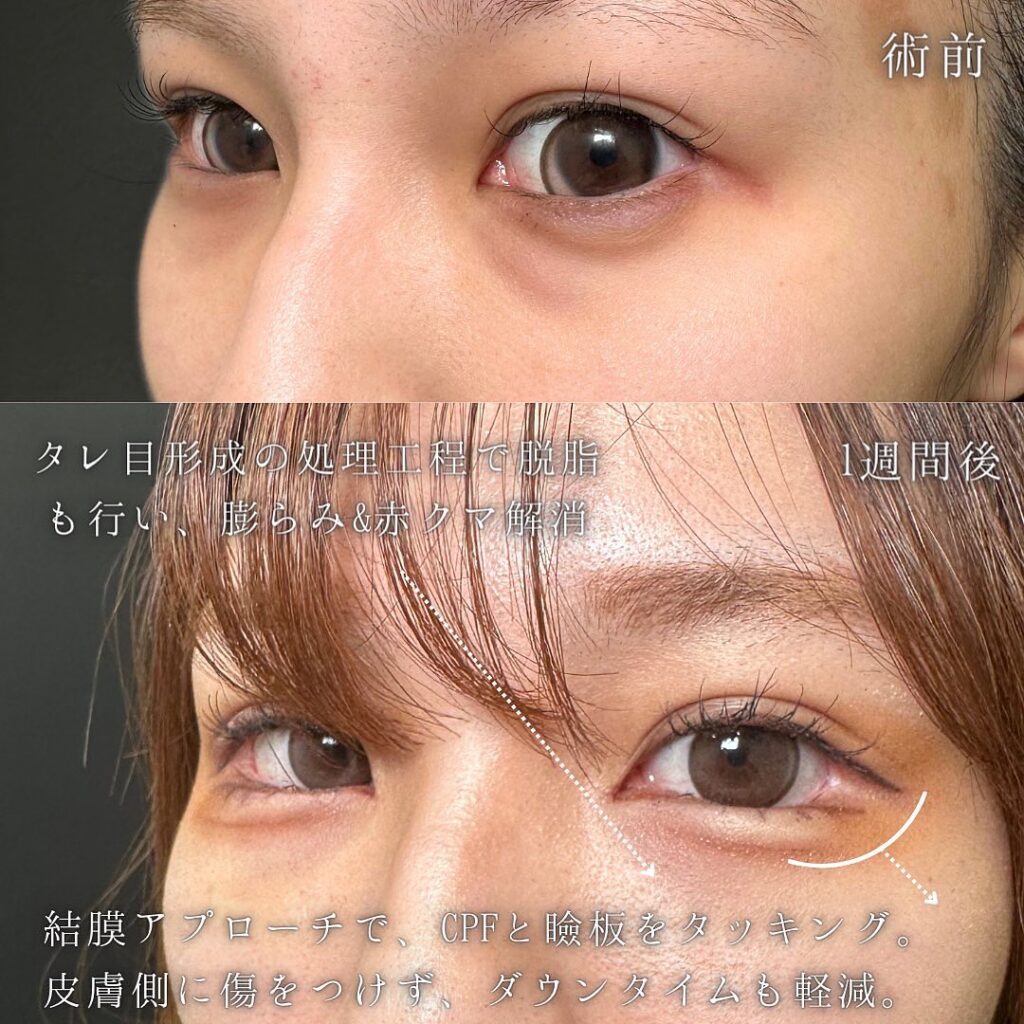 脱脂とタレ目形成の症例写真 (4)