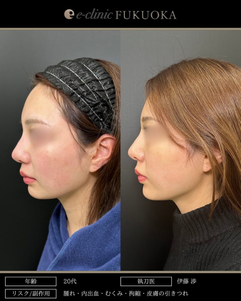 頬と顎下の脂肪吸引とジョールファットとバッカルファットと糸リフトの症例写真 (4)