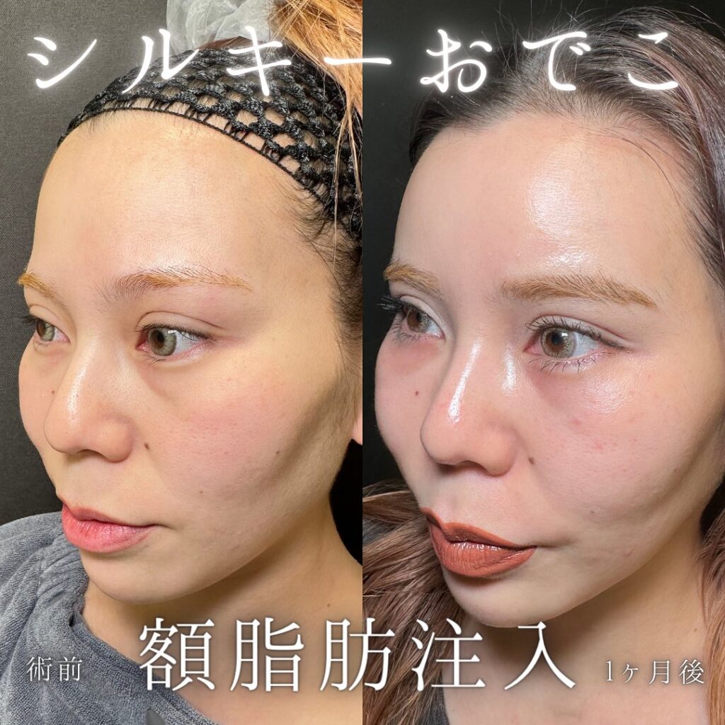 額の脂肪注入の症例写真 (4)