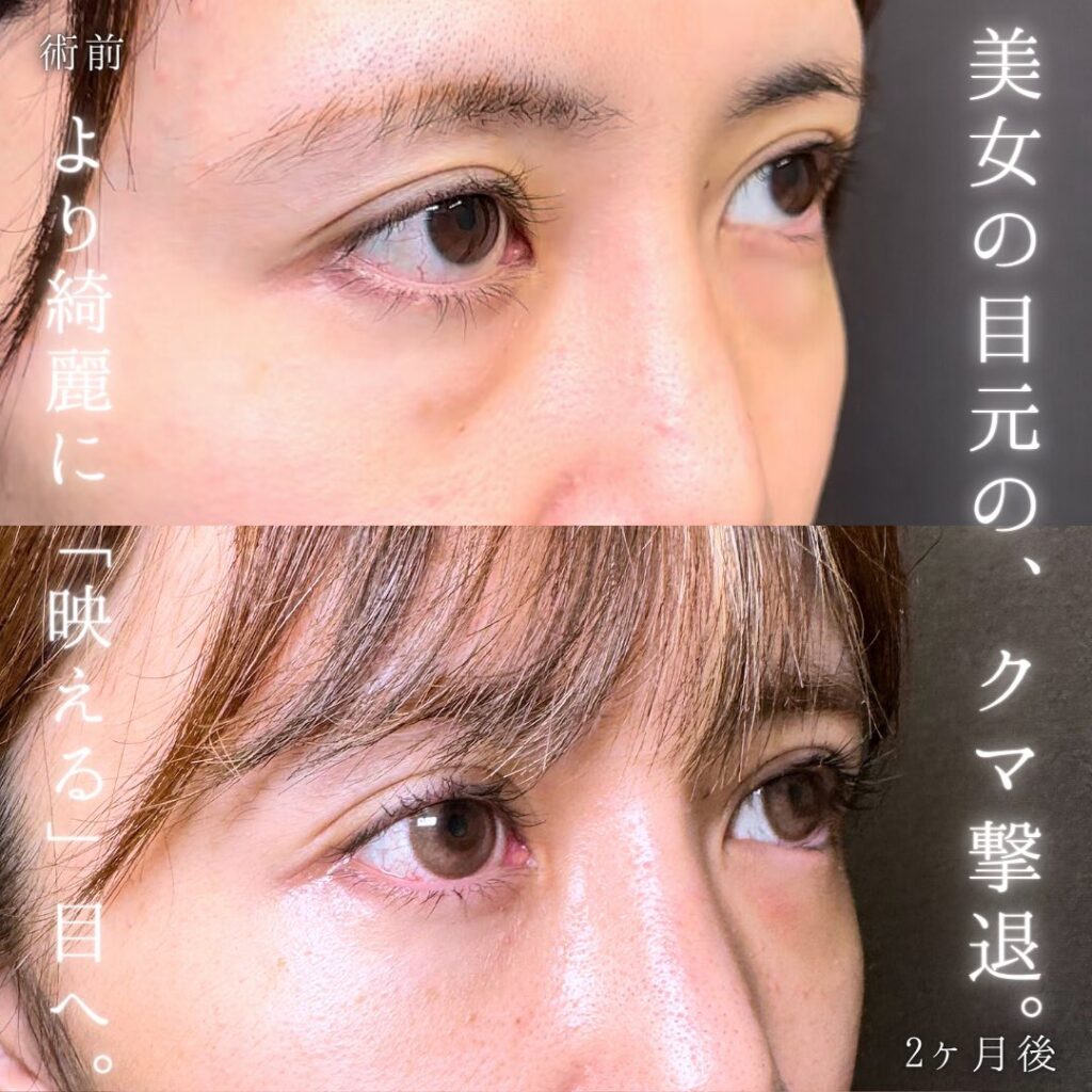 裏ハムラ法の症例写真 (23)