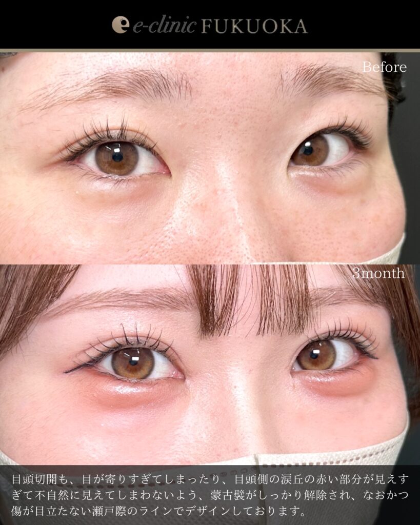 埋没法と目頭切開の症例写真 (13)