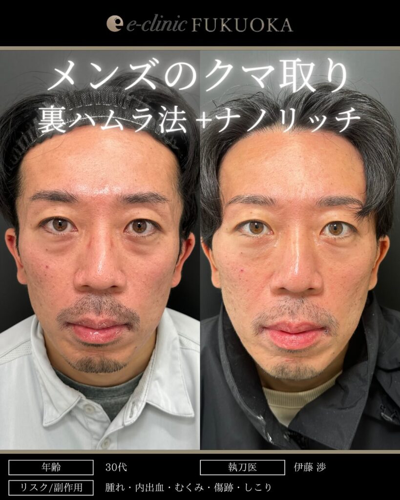 裏ハムラ法と脂肪注入の症例写真 (33)
