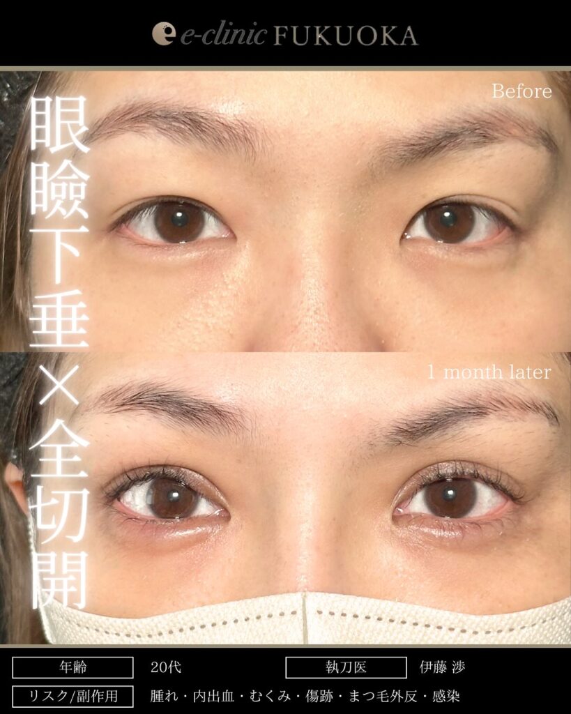 眼瞼下垂と全切開と涙袋のヒアルロン酸の症例写真 (1)