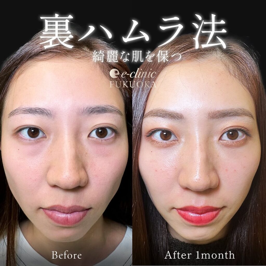 裏ハムラ法の症例写真 (85)