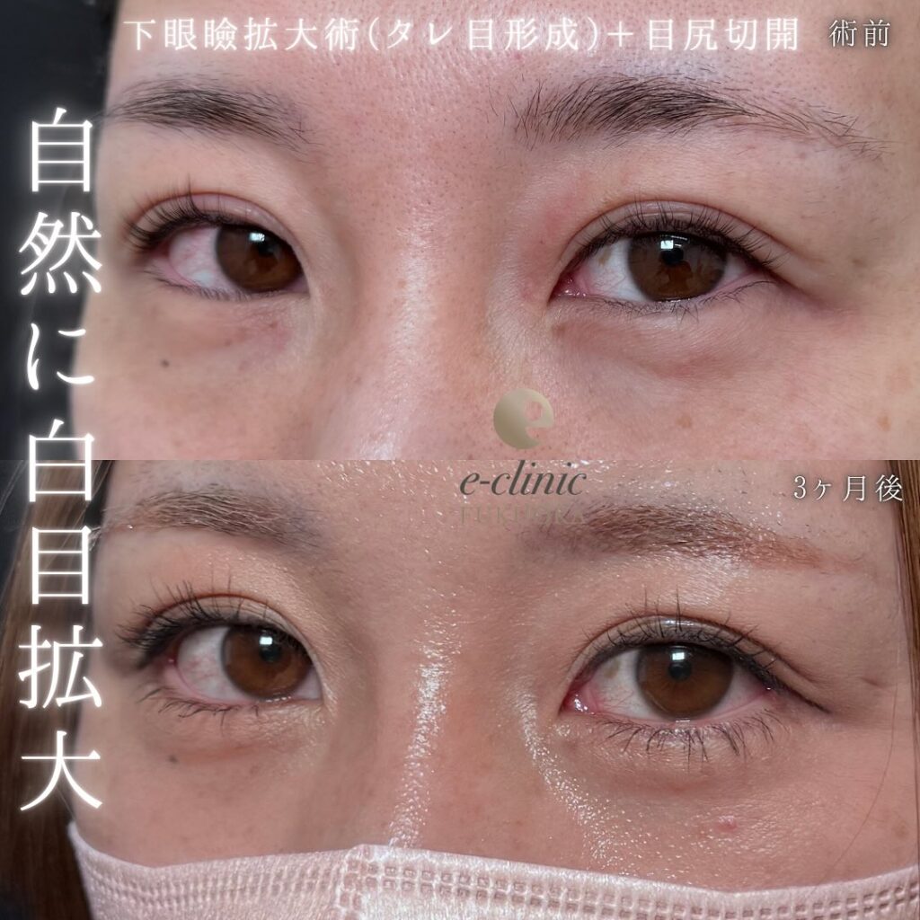 タレ目形成と目尻切開の症例写真 (7)