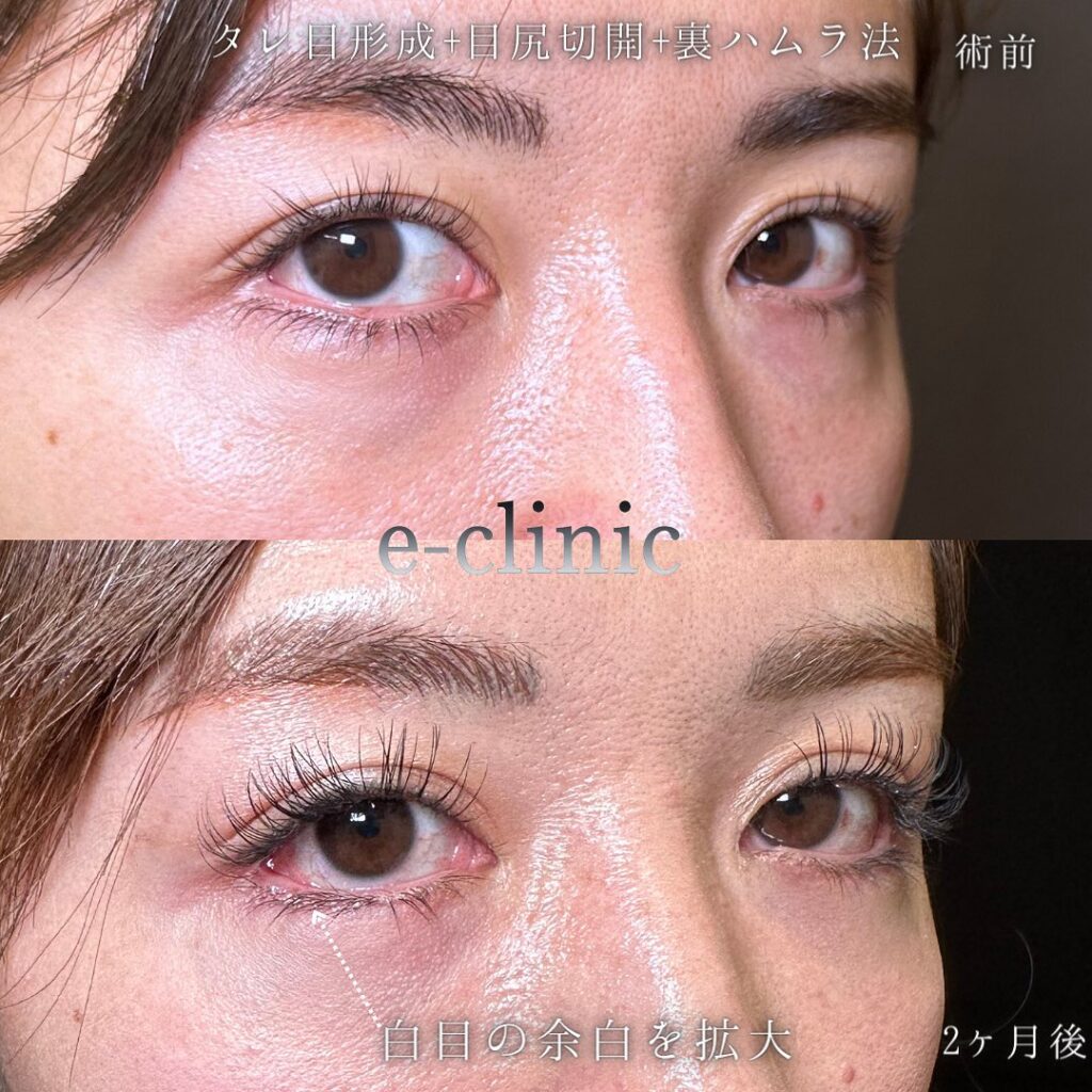 目尻切開とタレ目形成と裏ハムラ法の症例写真 (3)